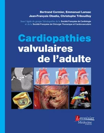 Cardiopathies valvulaires de l'adulte